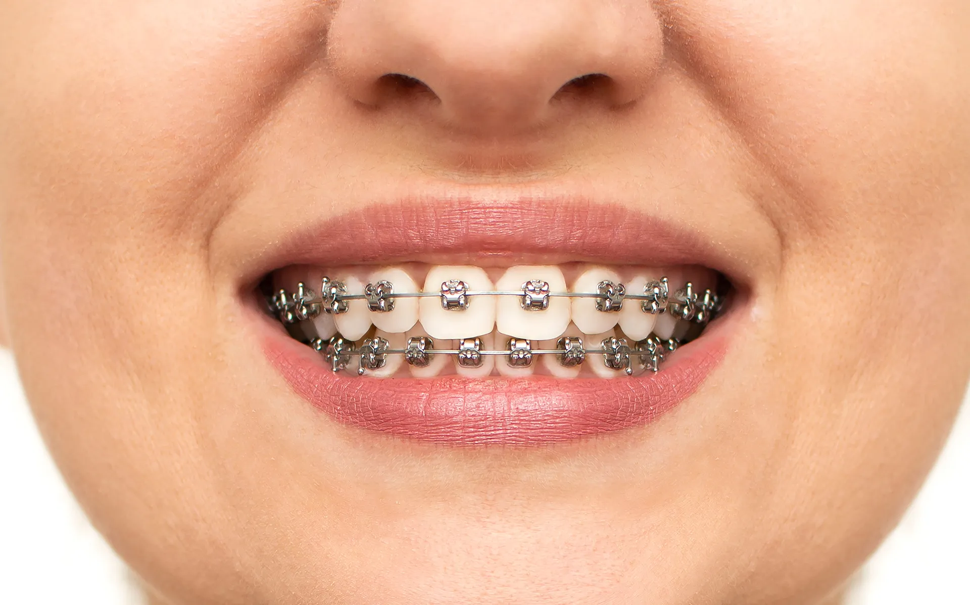 metal-braces-for-adults-in-london-freshdental